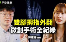 忍痛20年！我動了雙腳拇指外翻微創手術：費用、恢復期、手術方式大公開！ ft.陳建樺 足踝專科醫師【早安健康 × 樂活人物】